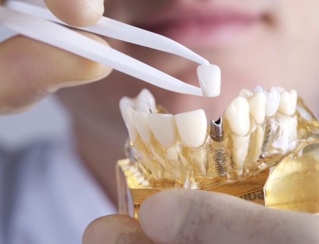 Dentist placing crown on model of dental implant in jaw