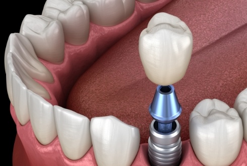 Dental crown being placed onto dental implant