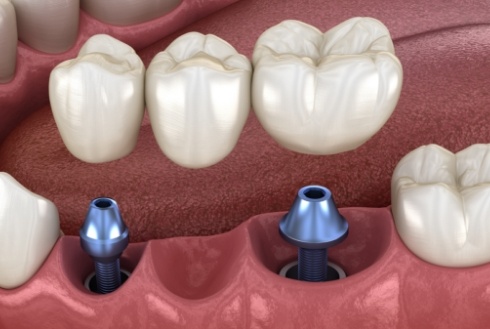 Dental bridge being placed onto two dental implants