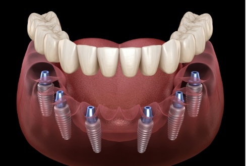 Full denture being placed onto six dental implants