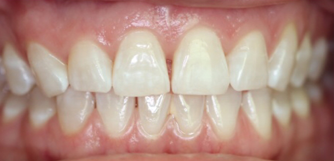 Close up of slightly yellowed teeth