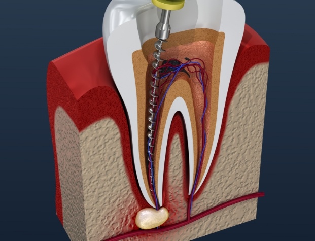 Illustrated dental instrument cleaning inside of tooth