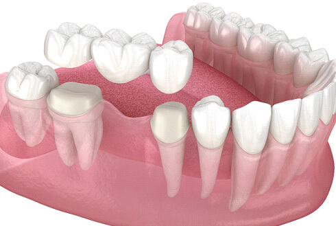 3D render of a dental bridge