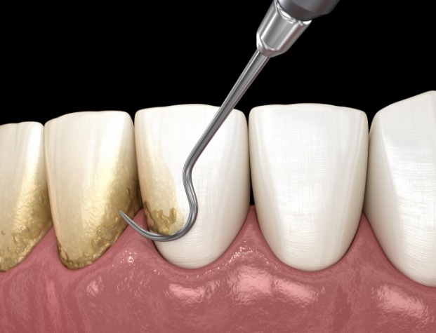 Illustrated dental instrument removing plaque buildup from teeth