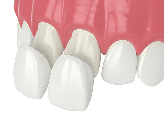 Illustration of veneers being placed on front teeth