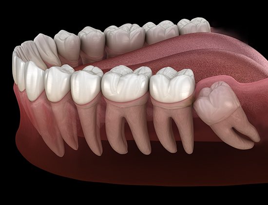 Digital illustration of wisdom teeth 